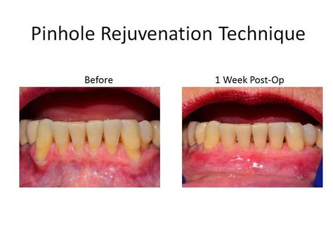 periodontist pinhole technique near me.